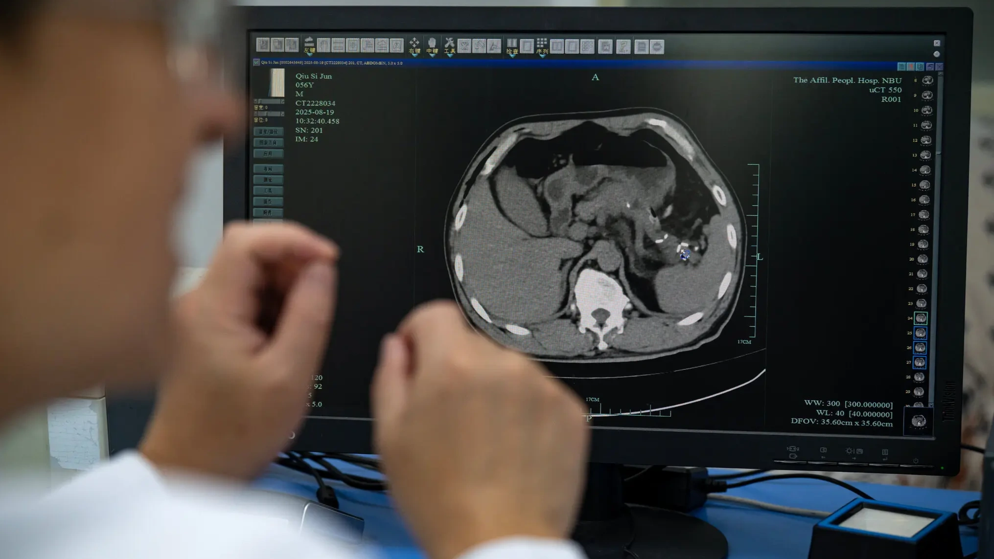 China’s AI Is Saving Cancer Patients Missed by Doctors